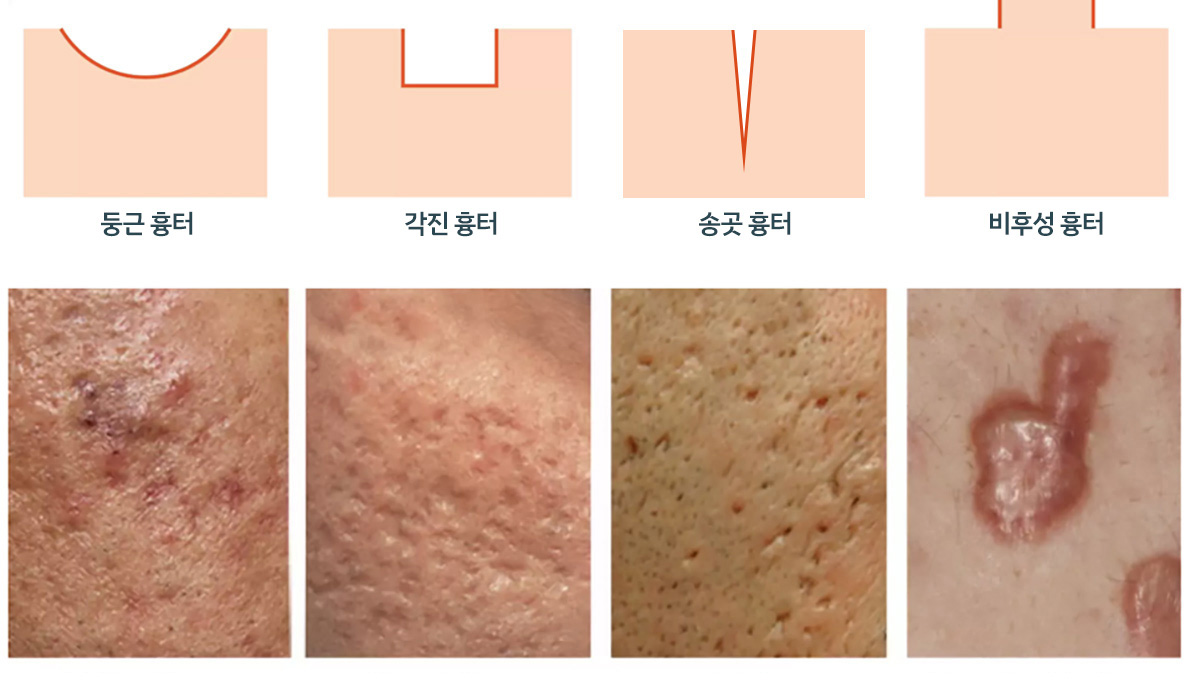 여드름